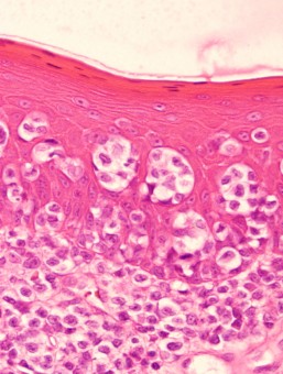 epitheliotropic lymphoma, skin, dog