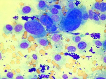 histiocytic sarcoma, spleen