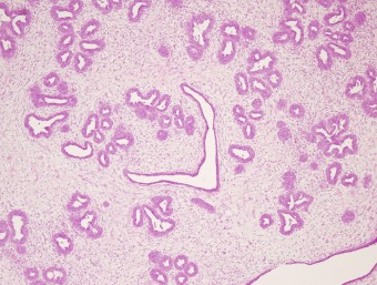 mammary fibroadneomatosis-cat